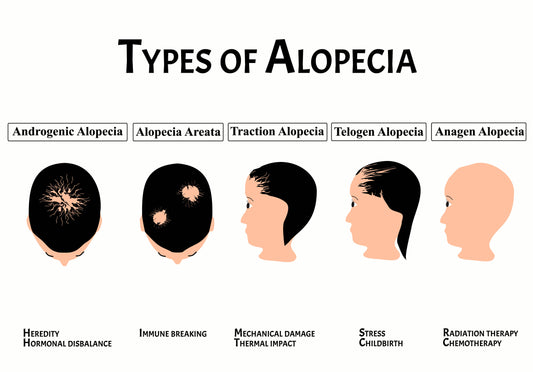 Autoimmune Diseases That Cause Hair Loss (Part 1) - Alopecia