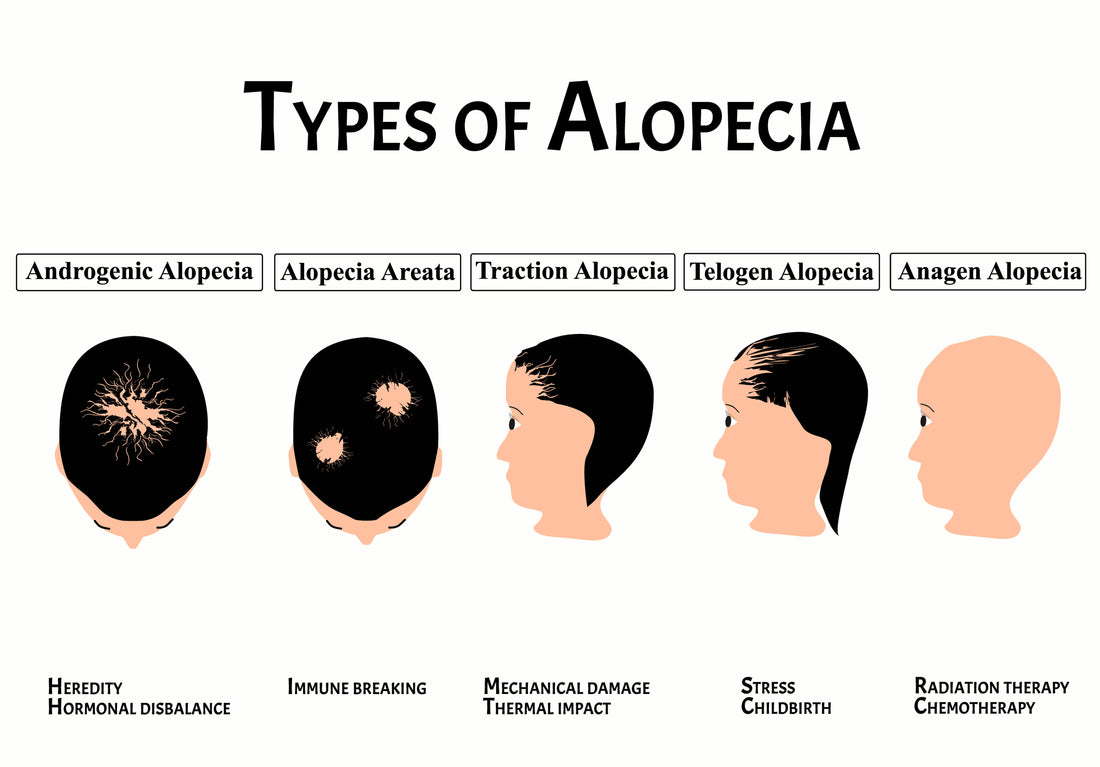 Autoimmune Diseases That Cause Hair Loss (Part 1) - Alopecia