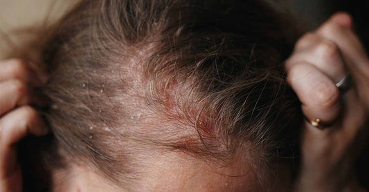 Psoriasis, A Look at the Scalp (Part 2)